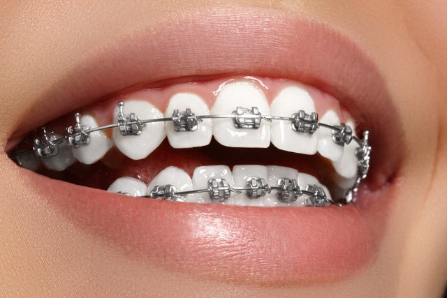 Răng Mọc Không Đều - Phương Pháp Điều Trị Nào Hiệu Quả Nhất?- ảnh 6