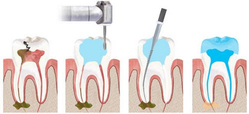 Lấy Tủy Răng Có Đau Không? Quy Trình Điều Trị Tủy Răng Như Thế Nào? - ảnh 4