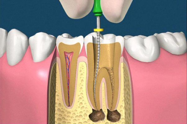 Có Nên Lấy Tủy Răng Để Bọc Sứ Không? Những Lưu Ý Quan Trọng Cần Biết - ảnh 5