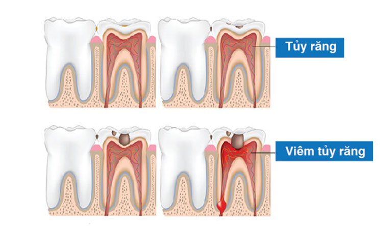 Lấy Tủy Răng Có Đau Không? Quy Trình Điều Trị Tủy Răng Như Thế Nào? - ảnh 5