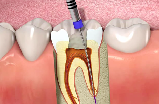 Răng Sâu Vào Tủy Là Gì – Răng Sâu Vào Tủy Có Nên Nhổ Răng Không? - ảnh 5