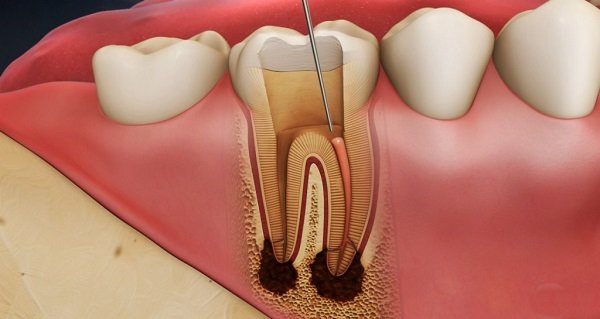 Viêm Chân Răng Có Mủ - Nguyên Nhân Và Cách Điều Trị Hiệu Quả - ảnh 10