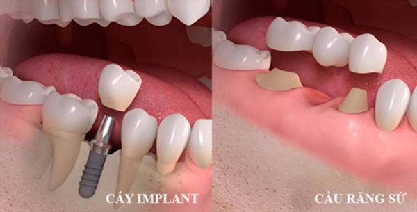 Bị Mất Răng Nên Làm Cầu Răng Sứ Hay Cấy Ghép Implant - ảnh 1