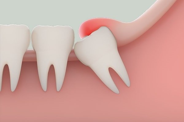 Sưng Răng Khôn Có Mủ Là Gì? Nguyên Nhân Gây Ra Và Cách Khắc Phục Hiệu Quả - ảnh 1