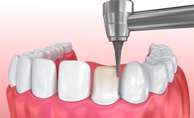 Thực Hư Bọc Răng Sứ Không Mài Nhỏ Răng – Nha Khoa Quốc Tế Á Châu - ảnh 1