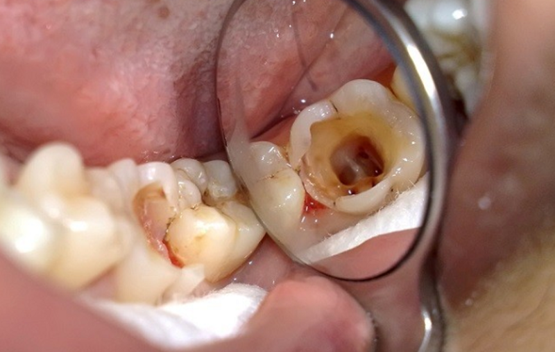 Răng Sâu Có Nên Bọc Răng Sứ? – Nha Khoa Quốc Tế Á Châu - ảnh 1