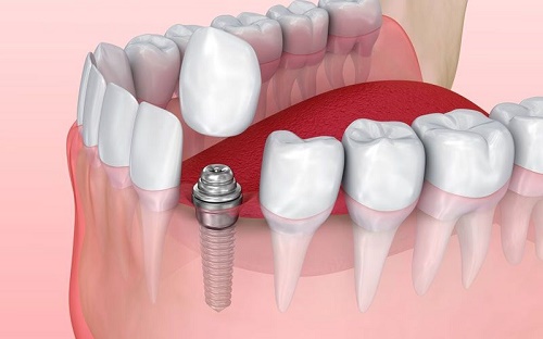 Cấy Ghép Implant Mất Bao Lâu? Giải Pháp Rút Ngắn Thời Gian Trồng Răng Implant - ảnh 6
