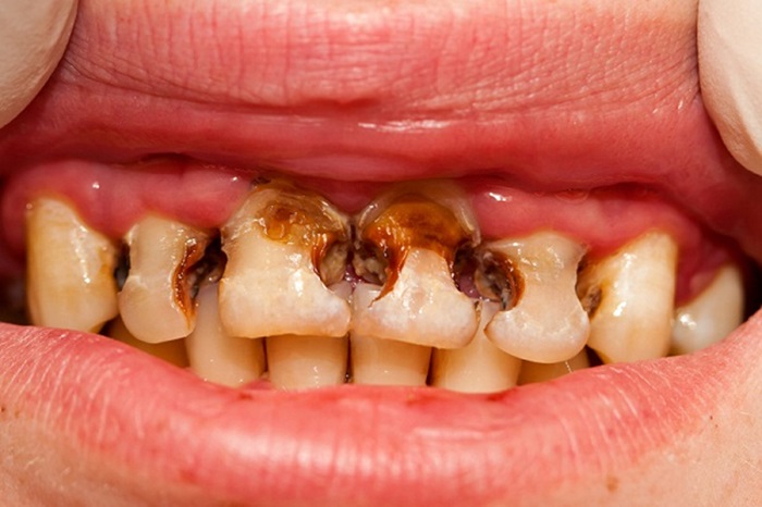 Sâu răng trẻ em, các điểm cần lưu ý T12-9