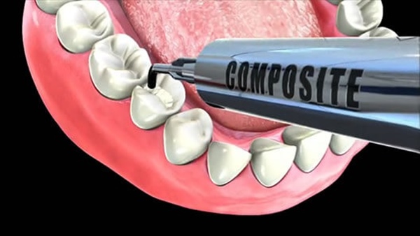 Quá trình hàn răng sâu có đau không? 

