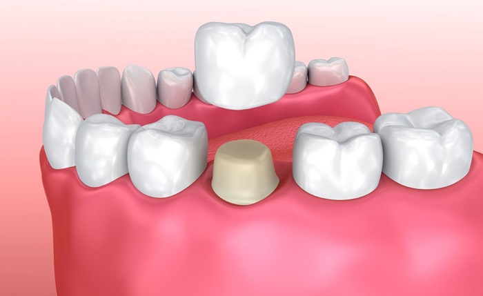 Thực Hư Bọc Răng Sứ Không Mài Nhỏ Răng – Nha Khoa Quốc Tế Á Châu - ảnh 2