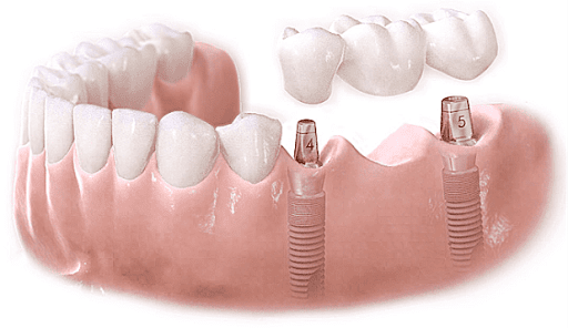 Mất Răng Hàm Và Cách Khắc Phục Hoàn Hảo – Nha Khoa Quốc Tế Á Châu - ảnh 15