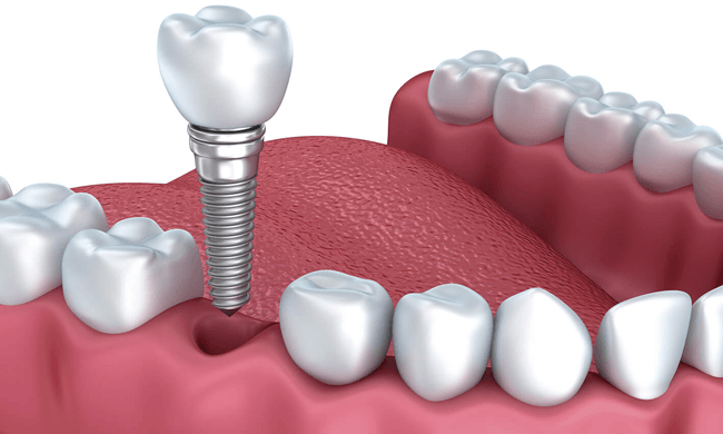 Cấy Ghép Implant Mất Bao Lâu? Giải Pháp Rút Ngắn Thời Gian Trồng Răng Implant - ảnh 2