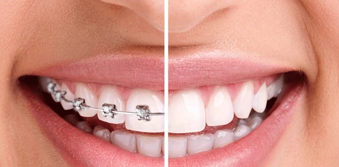 Bọc Răng Sứ Rồi Có Thể Niềng Răng Không? Nha Khoa Quốc Tế Á Châu - ảnh 1