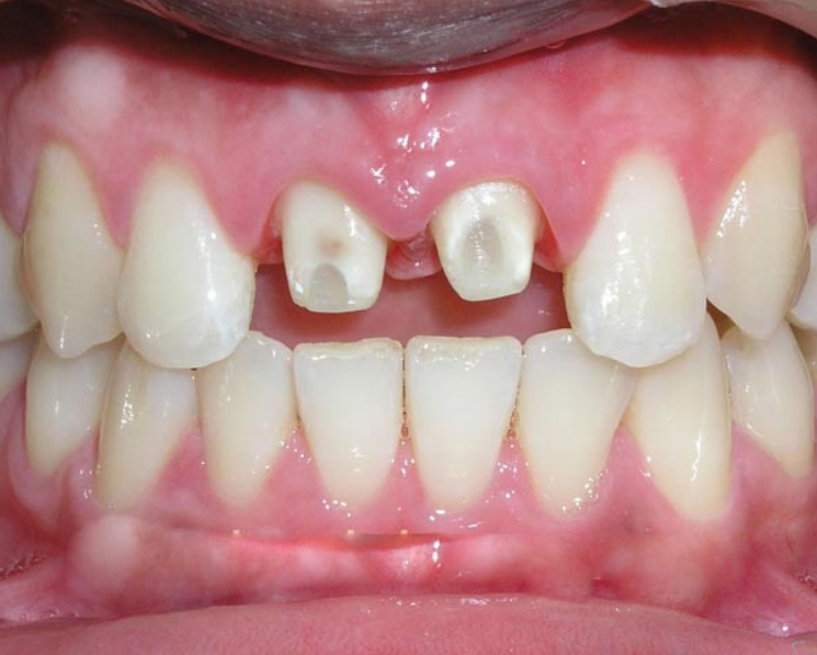 Bọc Răng Sứ Rồi Có Thể Niềng Răng Không? Nha Khoa Quốc Tế Á Châu - ảnh 5