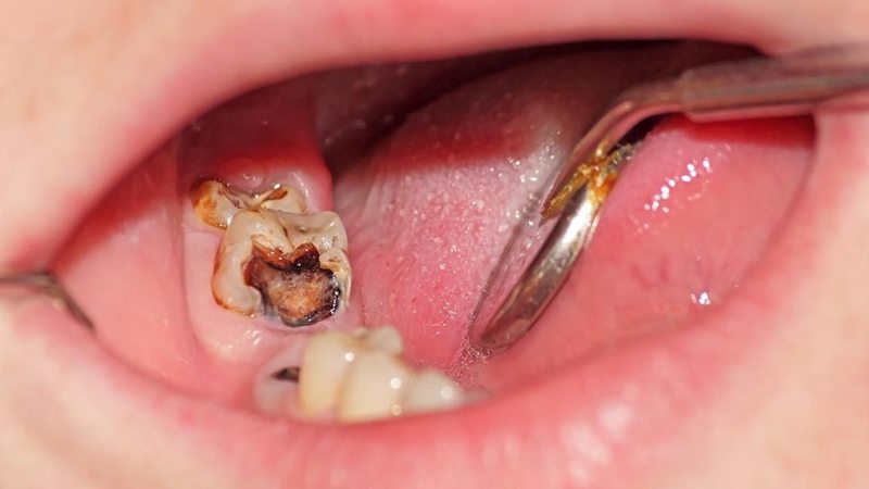 Răng Sâu Có Nên Bọc Răng Sứ? – Nha Khoa Quốc Tế Á Châu - ảnh 3