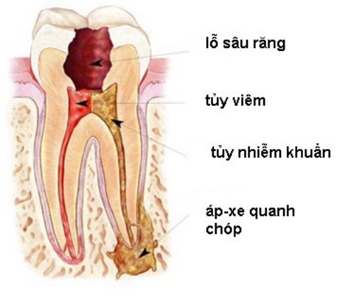 Viêm Chân Răng Có Mủ - Nguyên Nhân Và Cách Điều Trị Hiệu Quả - ảnh 3