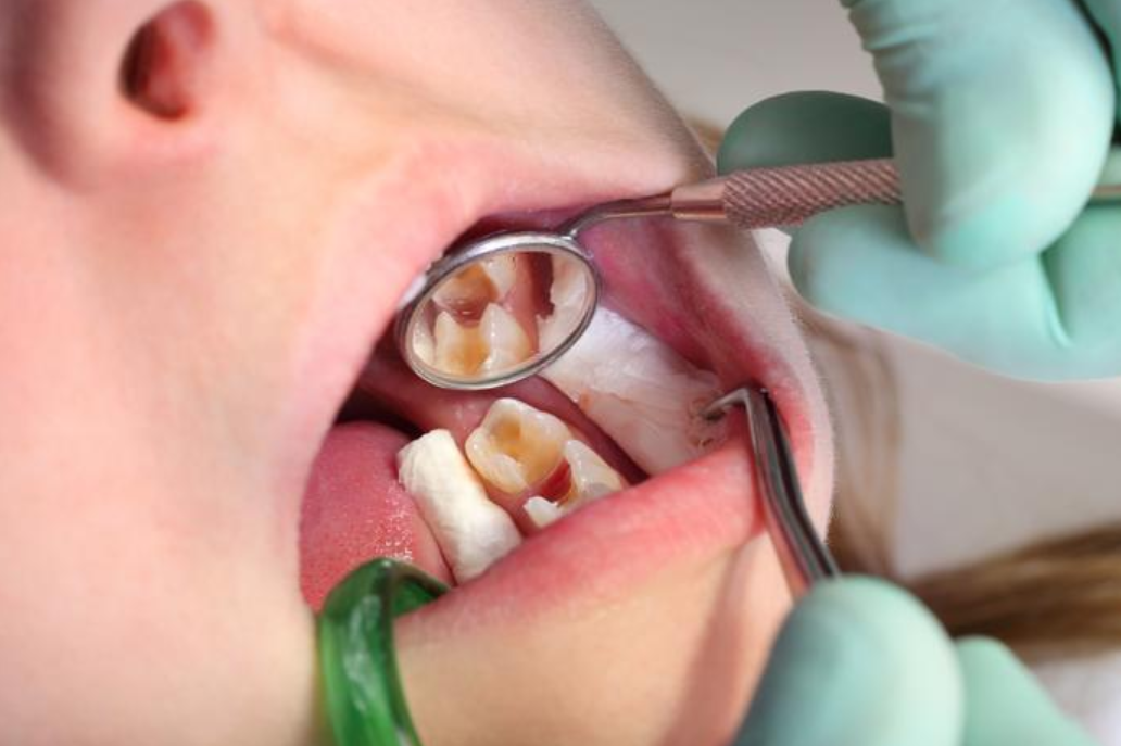 Lấy Tủy Răng Có Đau Không? Khi Nào Nên Lấy Tủy Răng? Nha Khoa Quốc Tế Á Châu - ảnh 3