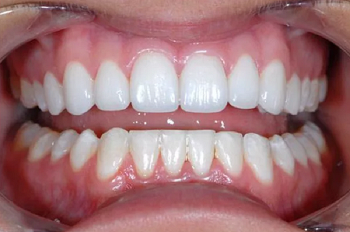Bọc Răng Sứ Rồi Có Thể Niềng Răng Không? Nha Khoa Quốc Tế Á Châu - ảnh 6
