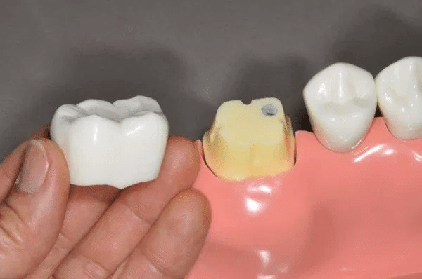 Răng Sâu Có Nên Bọc Răng Sứ? – Nha Khoa Quốc Tế Á Châu - ảnh 4
