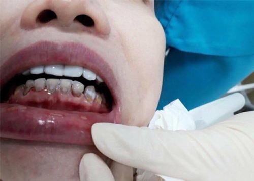 Làm Cầu Răng Sứ Có Gây Hôi Miệng Không? – Nha Khoa Quốc Tế Á Châu - ảnh 4
