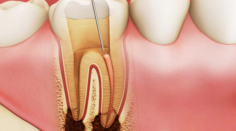 Lấy Tủy Răng Có Đau Không? Khi Nào Nên Lấy Tủy Răng? Nha Khoa Quốc Tế Á Châu - ảnh 5