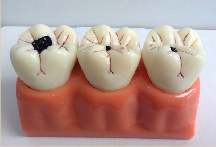 Răng Sâu Có Nên Bọc Răng Sứ? – Nha Khoa Quốc Tế Á Châu - ảnh 5