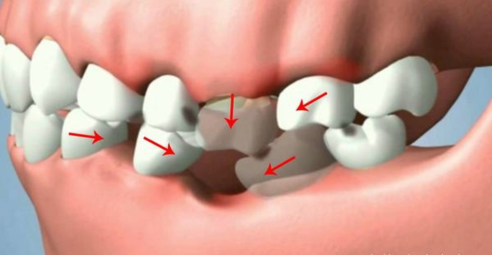 Bị Mất Răng Có Thể Niềng Răng Không? – Nha Khoa Quốc Tế Á Châu - ảnh 4