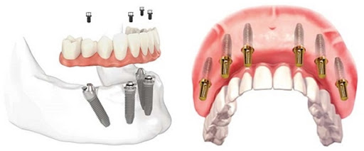 Cấy Ghép Implant Mất Bao Lâu? Giải Pháp Rút Ngắn Thời Gian Trồng Răng Implant - ảnh 7