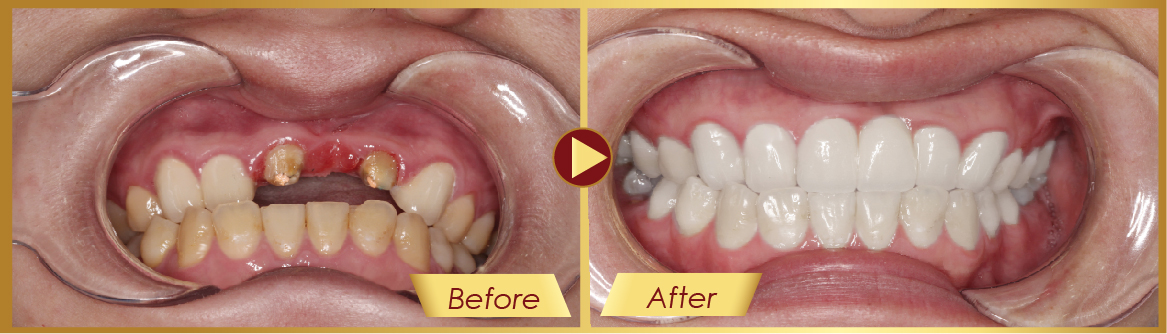 Bị Mất Răng Nên Làm Cầu Răng Sứ Hay Cấy Ghép Implant - ảnh 8