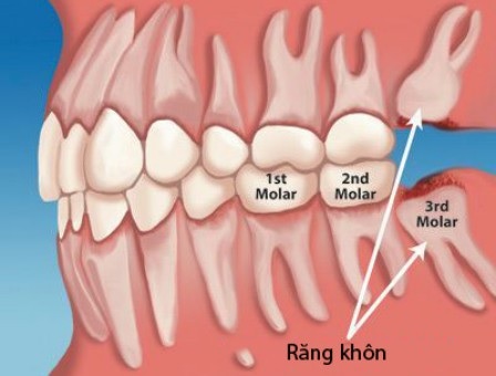 Bao Nhiêu Tuổi Thì Mọc Răng Khôn? Độ Tuổi Mọc Răng Khôn Chính Xác - ảnh 4