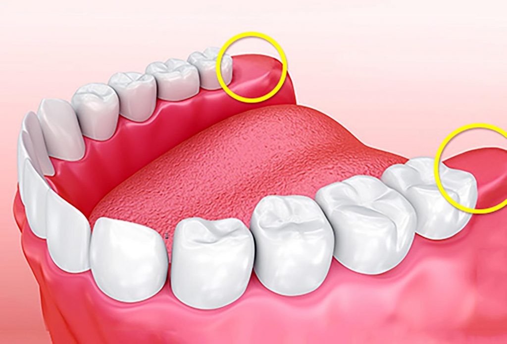 Bao Nhiêu Tuổi Thì Mọc Răng Khôn? Độ Tuổi Mọc Răng Khôn Chính Xác - ảnh 5