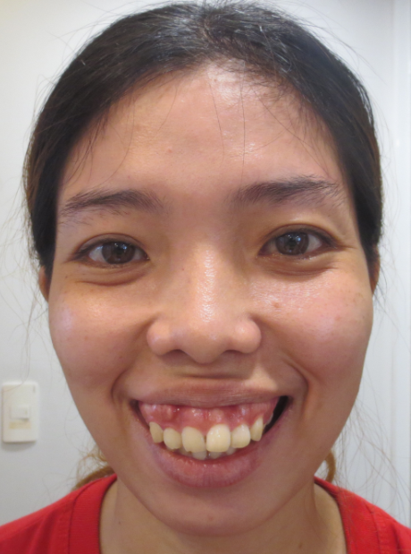 Bị Hô Hàm Có Niềng Răng Được Không? – Nha Khoa Quốc Tế Á Châu - ảnh 4