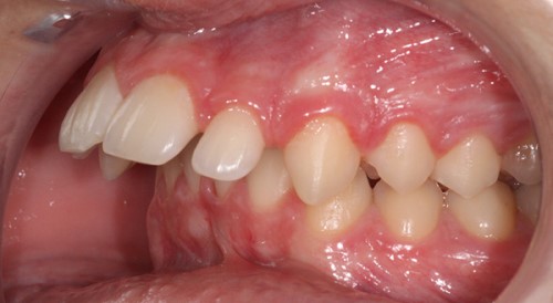 Bị Hô Hàm Có Niềng Răng Được Không? – Nha Khoa Quốc Tế Á Châu - ảnh 5