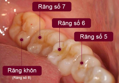 Bao Nhiêu Tuổi Thì Mọc Răng Khôn? Độ Tuổi Mọc Răng Khôn Chính Xác - ảnh 6