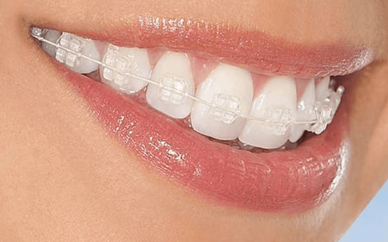 Bị Hô Hàm Có Niềng Răng Được Không? – Nha Khoa Quốc Tế Á Châu - ảnh 6