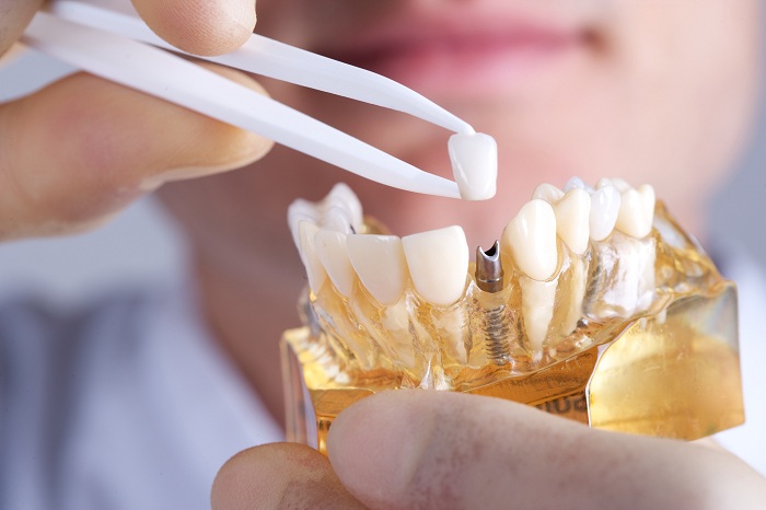 Các Bước Trồng Răng Implant Chuẩn? – Nha Khoa Quốc Tế Á Châu - ảnh 1