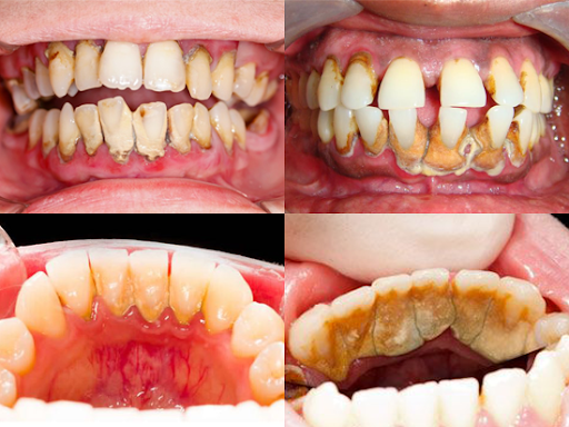 Bao Lâu Lấy Cao Răng 1 Lần? – Nha Khoa Quốc Tế Á Châu - ảnh 1