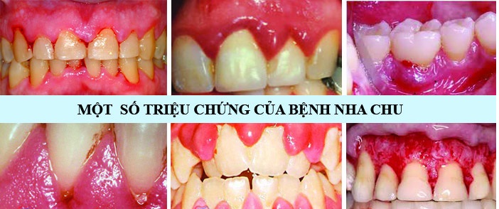 Bệnh Nha Chu – Dấu Hiệu Nhận Biết Và Phương Pháp Điều Trị - ảnh 5