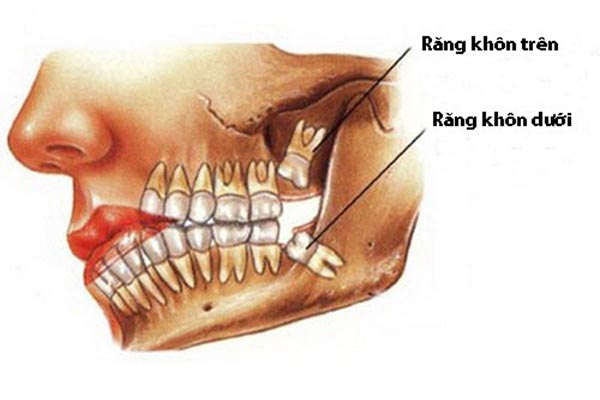 Tổng Hợp Những Kinh Nghiệm Nhổ Răng Khôn Từ A Đến Z - ảnh 2