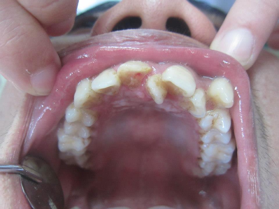 Răng Thừa Mọc Giữa 2 Răng Cửa Phải Làm Sao? – Nha Khoa Quốc Tế Á Châu - ảnh 2