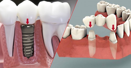 Nên Làm Cầu Răng Hay Là Cấy Ghép Implant? – Nha Khoa Quốc Tế Á Châu - ảnh 2