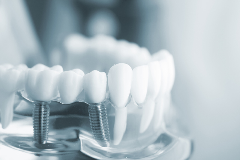 Nên Làm Cầu Răng Hay Là Cấy Ghép Implant? – Nha Khoa Quốc Tế Á Châu - ảnh 3