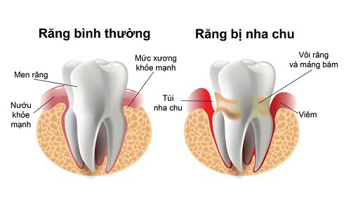 Bệnh Nha Chu – Dấu Hiệu Nhận Biết Và Phương Pháp Điều Trị - ảnh 2