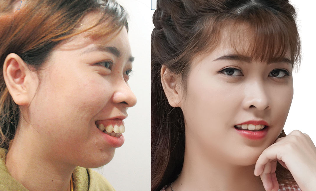 Bị Hô Hàm Có Niềng Răng Được Không? – Nha Khoa Quốc Tế Á Châu - ảnh 10