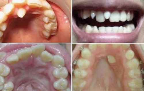 Răng Thừa Mọc Giữa 2 Răng Cửa Phải Làm Sao? – Nha Khoa Quốc Tế Á Châu - ảnh 3