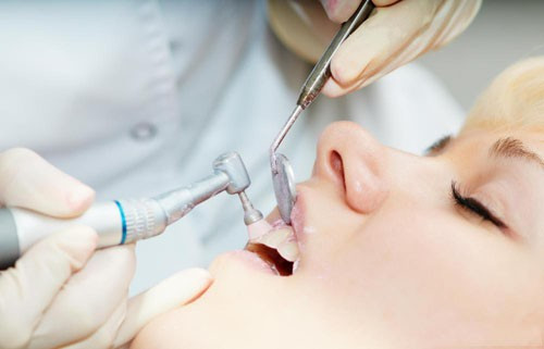 Lấy Cao Răng Có Làm Hỏng Men Răng Không? – Nha Khoa Quốc Tế Á Châu - ảnh 4
