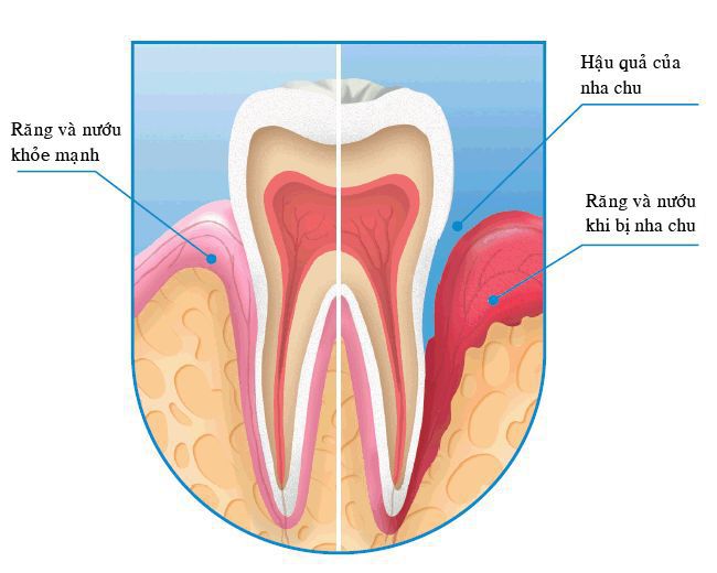 Bệnh Nha Chu – Dấu Hiệu Nhận Biết Và Phương Pháp Điều Trị - ảnh 3