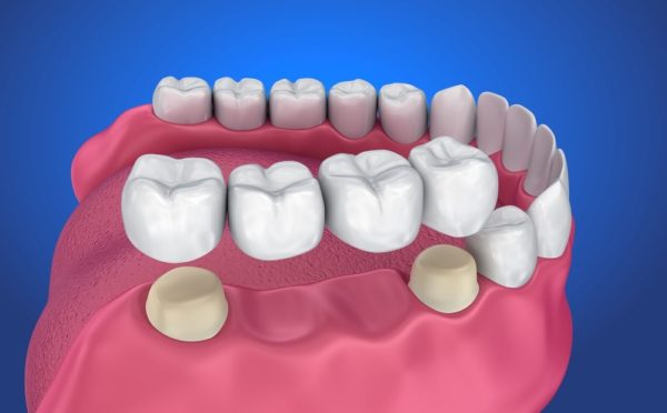 Nên Làm Cầu Răng Hay Là Cấy Ghép Implant? – Nha Khoa Quốc Tế Á Châu - ảnh 7