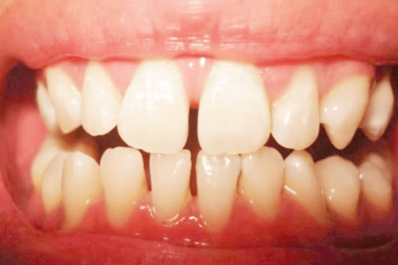 Nhổ Răng Bao Lâu Thì Gắn Niềng Răng? – Nha Khoa Quốc Tế Á Châu - ảnh 7