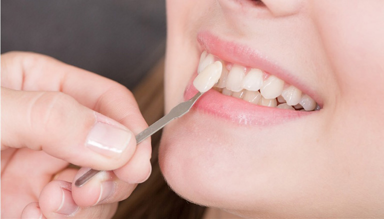 Răng Thừa Mọc Giữa 2 Răng Cửa Phải Làm Sao? – Nha Khoa Quốc Tế Á Châu - ảnh 7